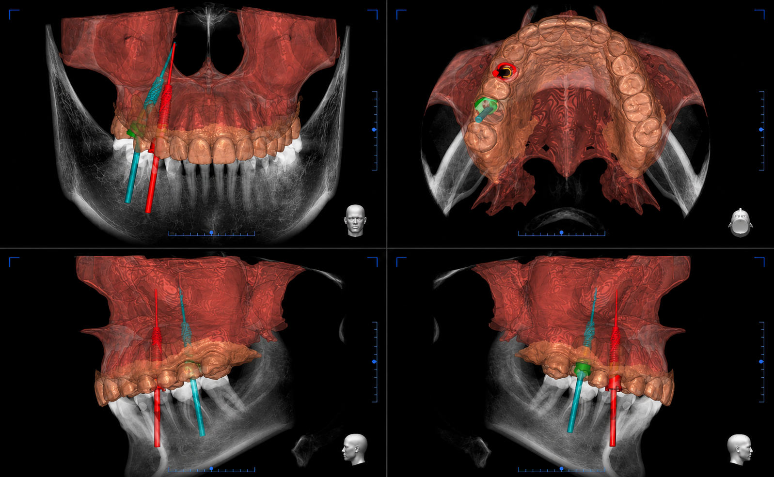CBCT планирование имплантации